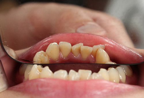 Diş Eti Estetiği Nedir? Estetik Diş Etinin Faydalar�